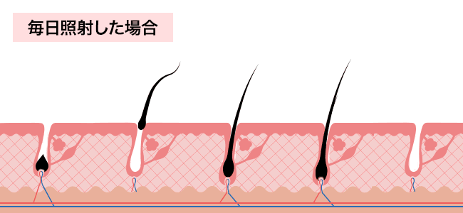 レーザーを毎日照射した場合
